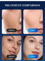 Portable Skin Rejuvenation Anti-Acne Beauty Machine Stretch Marks Remover Wrinkle Removal Anti-aging Skincare Appliance